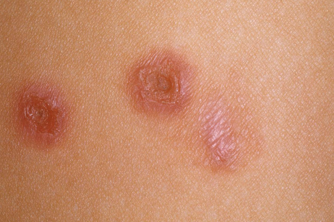 Οξεία και χρόνια κνίδωση